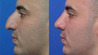 جراحی زیبایی بینی تاریخ را با عنوان دیگری تکرار کنید