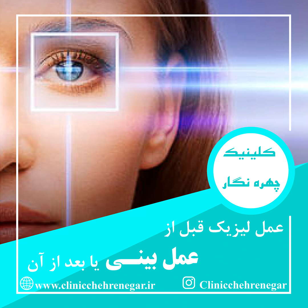 جراحی لیزیک چشم