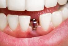 بررسی و مقایسه سه روش ایمپلنت دیجیتال، فوری و مینی ایمپلنت