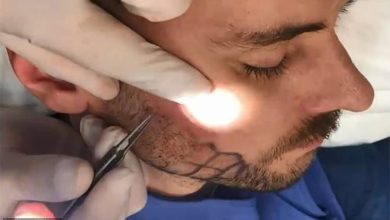 دلایل اکتسابی ریزش ریش و سبیل آقایان