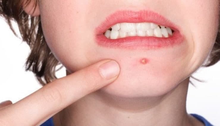 راهکارهای خانگی برای درمان جوش‌های صورت