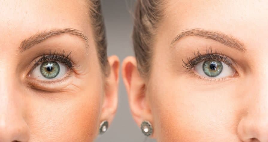 علت چروک و سیاهی دور چشم