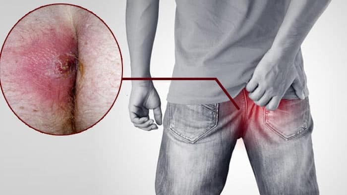 علت برگشت آبسه مقعدی