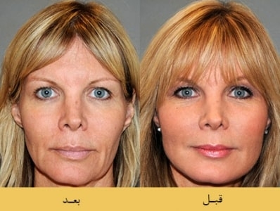 لیفت بهتره یا کشیدن پوست