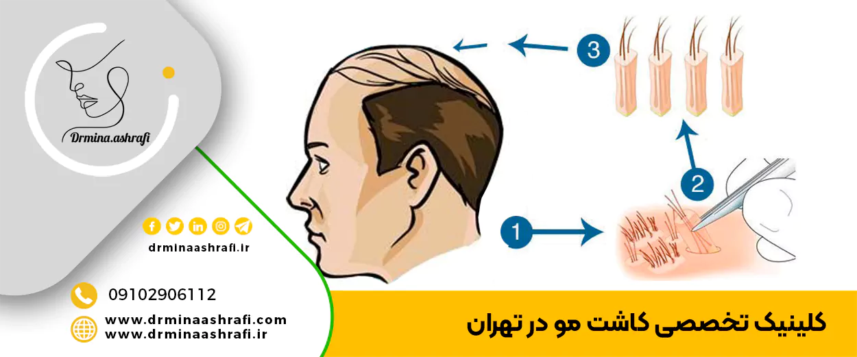 معرفی بهترین مراکز کاشت مو در تهران