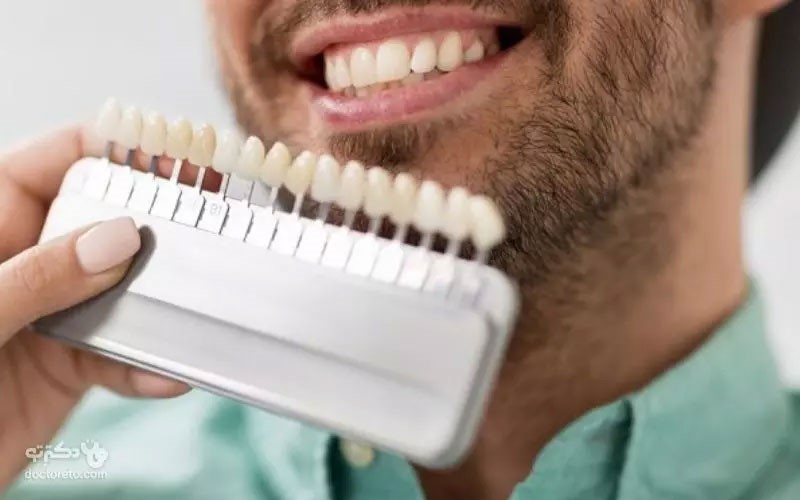 هزینهٔ انواع لمینت دندان در کلینیک دکترتو در سال ۱۴۰۲