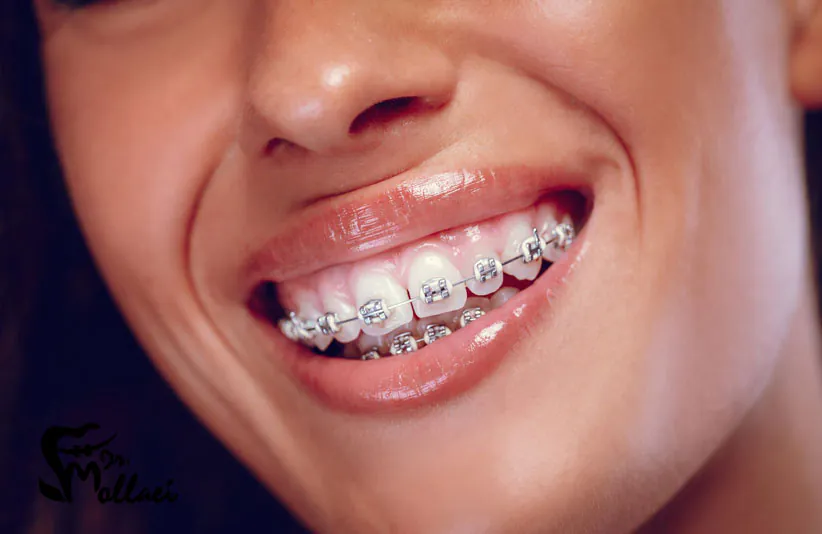 ارتودنسی ثابت، پرکاربردترین روش ارتودنسی دندان