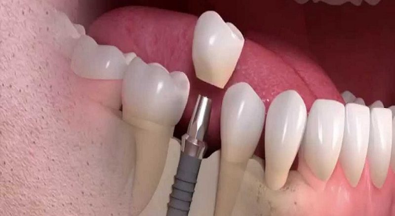 آشنایی با نحوه انجام ایمپلنت دندان به زبان ساده