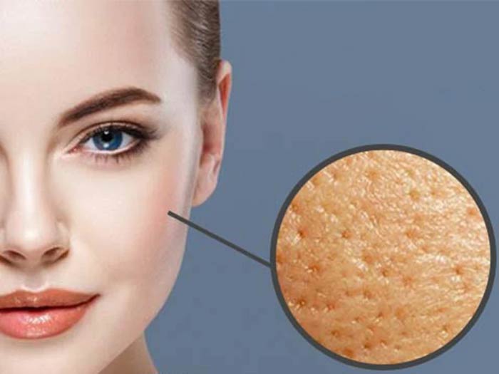 صفر تا صد درمان منافذ باز پوست با میکرونیدلینگ