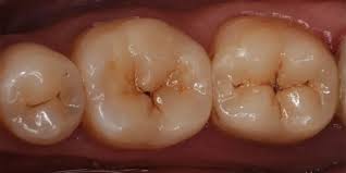 پوسیده شدن دندان زیر لمینت چگونه ترمیم می شود؟